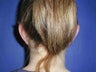 Otoplasty