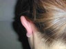 One ear Otoplasty