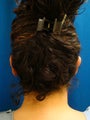 Ear Surgery (otoplasty)