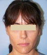 Otoplasty Ear Surgery