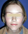 Otoplasty Surgery