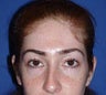 Otoplasty (Ear) Surgery