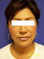 Otoplasty Ear Surgery