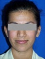 Otoplasty Ear Surgery