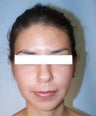 Ear Surgery (otoplasty)