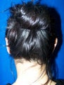 Ear Surgery (otoplasty)