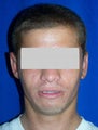 Ear Surgery (otoplasty)