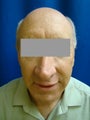 Ear Surgery (Otoplasty)