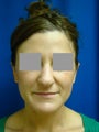 Ear Surgery (Otoplasty)