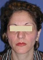Ear Surgery (Otoplasty)