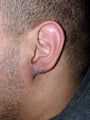 Ear Surgery