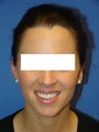 Otoplasty (Ear Surgery)