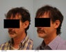 Otoplasty
