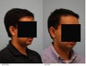 Otoplasty