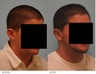 Otoplasty
