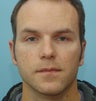 Otoplasty