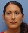 Otoplasty