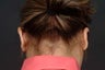 Otoplasty