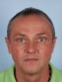 Otoplasty in Adult Male