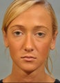 Corrective Ear Surgery