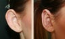 Otoplasty