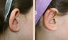 Otoplasty