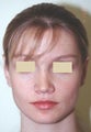 Otoplasty