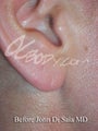 Ear Repair - Earlobe