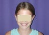 Otoplasty