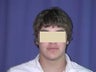 Otoplasty