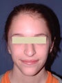 Otoplasty (correction of outstanding ears)