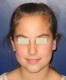 Ear Surgery (Otoplasty or Ear Pinning)