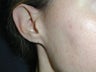 Ear reconstruction for missing earlobe