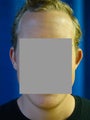 Otoplasty (Ear Surgery)
