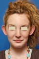 Otoplasty for prominent ears ("Ear Pinning")
