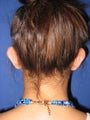 Otoplasty (Ear Surgery)