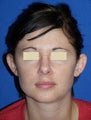 Otoplasty (Ear Surgery)