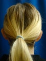 Ear Surgery (Otoplasty)