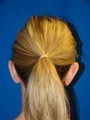 Ear Surgery (Otoplasty)