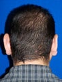 Ear Surgery (otoplasty)