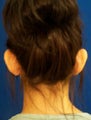 Ear Surgery (otoplasty)