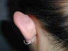 One ear Otoplasty
