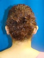 Ear Surgery (otoplasty)