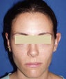 Otoplasty Ear Surgery