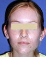 Otoplasty Surgery