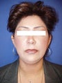 Otoplasty Ear Surgery