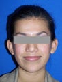 Otoplasty Ear Surgery