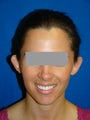 Ear Surgery (otoplasty)