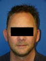 Ear Surgery (otoplasty)