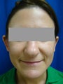 Ear Surgery (Otoplasty)